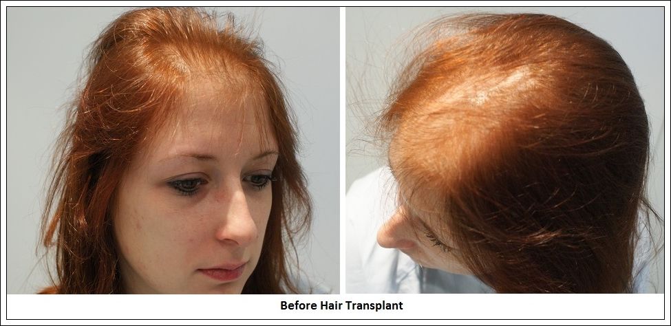implant cheveux femme avis implant cheveux femme avis